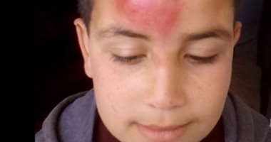 تلميذ يتعرض للضرب على يد زميله بإحدى مدارس كفر الشيخ والأم تشكو إهمال المدرسة