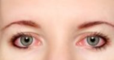أخصائى عيون: الماء البارد أفضل علاج لحساسية العين الناتجة عن حرارة الجو