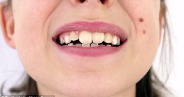 آلام الأسنان.. تعرف على أهم العلاجات المنزلية