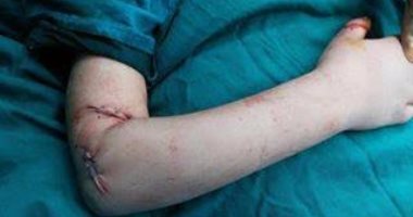 بالصور.. فريق طبي يستعيد ذراع مبتورة لطفلة عمرها ثلاث سنوات بدمياط