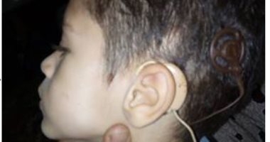 تعرف على شروط عملية زراعة القوقعة للأطفال ضعاف السمع