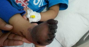 عرض طفل على الطب الشرعى لإصابته بغرغرينة بالقدم نتيجة إهمال طبى بأكتوبر