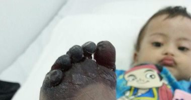 طفل يفقد قدمه نتيجة إهمال طبى فى مستشفى بأكتوبر
