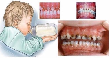 نصائح للتعامل مع تسوس أسنان الأطفال اللبنية