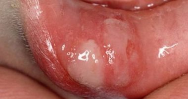 أعراض الهربس البسيط التى تصيب الفم والأعضاء التناسلية اليوم السابع