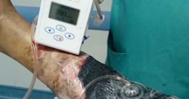 فريق طبى ينجح فى إنقاذ ساق مريض من البتر بطوارئ كفر سعد بدمياط