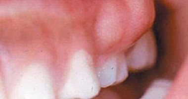 مؤشرات الإصابة بخراج الأسنان.. اعرف طرق الوقاية منه 