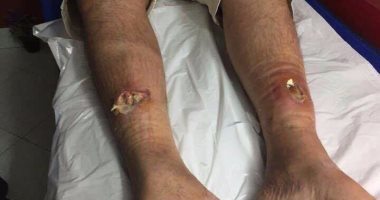 إصابة مواطن داخل لعبة ملاهى مائية بسبب عطلها فى شرم الشيخ