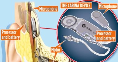 ثورة فى عالم الطب.. ابتكار أذن إلكترونية تُعيد السمع للصم 