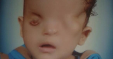 طفل عمره 3 سنوات مولود بدون فتحات فى العين ويحتاج جراحة بـ 300 ألف جنيه