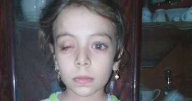 مادة كيميائية أفقدت الطفلة "نور" بصرها.. ووالدها يطالب بعلاجها