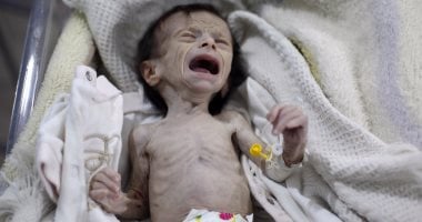 بالصور.. آلاف الأطفال يعانون من سوء التغذية فى أحد معاقل الفصائل المعارضة