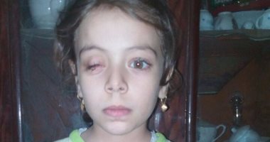 بالصور.. مأساة الطفلة "نور" فقدت عينها بسبب الكلور: نفسى أشوف تانى 