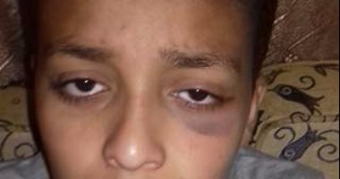 "زياد" ذهب للمدرسة وعاد بلكمة فى الوجه.. ووالده: مدرس ضربه