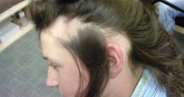 التعايش مع الأمراض المناعية.. كيف يمكن التعامل مع أعراض مرض الذئبة