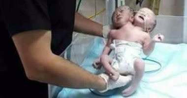 ولادة طفلين توأم برأسين وجسد واحد فى قطاع غزة