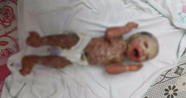 استجابة لـ"اليوم السابع".. الصحة تتواصل مع والد الطفل المصاب بالجلد الشمعى