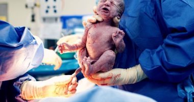 استشارى نساء وتوليد: الولادة القيصرية ليست سببا فى ولادة مبكرة بالمرة الثانية