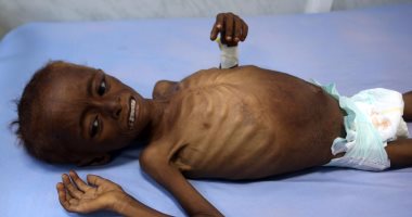 صور.. سوء التغذية والمجاعة تهدد مئات الأطفال فى اليمن
