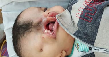 صور.. طفل يعانى من مرض نادر يحتاج لعلاج خارج مصر