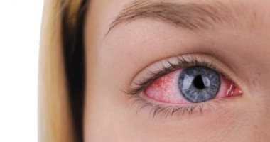 التهاب الملتحمة.. كيفية حماية العينين من العين الوردية