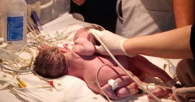 أول حالة ولادة لتوأم ملتصق البطن والصدر بمستشفى الأطفال بجامعة المنصورة