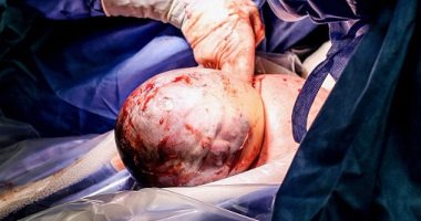ديلى ميل: ولادة طفلة أمريكية بداخل كيس الغشاء الأمنيوسى فى حالة نادرة.. صور