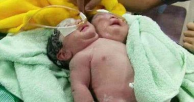 فيديو وصور.. ولادة توأمتين ملتصقتين بكمبوديا.. والأم: أشعر بسعادة وحزن