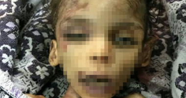 الطب الشرعى بالشرقية: الطفلة شهد ضحية خلافات زوجية وعاشت 3 أيام بذراع مفصول