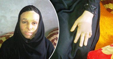 صور وفيديو.. "سمية" أجرت 18 عملية بسبب حرق فى وجهها لوزير الصحة: "نفسى أتعالج"
