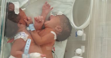 صور.. ولادة توأم ملتصق بمستشفى الشاطبى بالإسكندرية