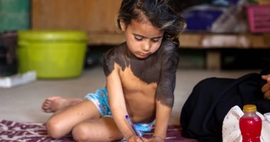 صور.. بالبراءة والبساطة.. طفلة عراقية تواجه مرض جلدى نادر 