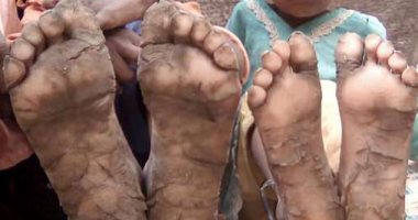 مأساة أسرة باكستانية.. تحول أرجل أطفال إلى حجارة بسبب مرض نادر.. صور