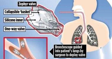 FDA توافق على جهاز جديد لعلاج صعوبة التنفس المرتبطة بانتفاخ الرئة