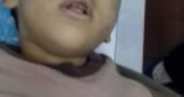 صحة الدقهلية: الطفل المعذب تم احتجازه بالرعاية لوجود آثار أطفاء سجائر بجسده