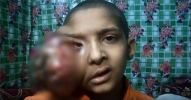 طفل مريض بسرطان الوجه يطالب بعلاجه بالخارج