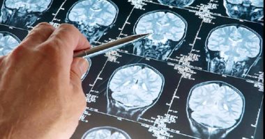 دراسة علمية تحذر: الأشعة المقطعية تزيد خطر الإصابة بأورام المخ