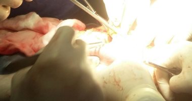صور.. مستشفى أورام الإسماعيلية يجرى لأول مرة عملية استئصال ورم بالمرئ