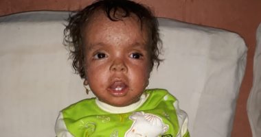 فيديو وصور.. مأساة الطفلة "كارما" بقنا.. تعانى من مرض جلدى نادر