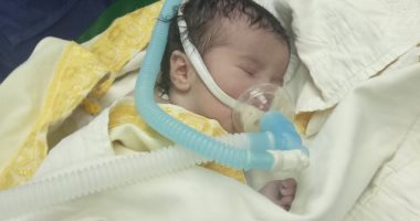 إجراء أول عملية لإصلاح عيب خلقى بطفله وليدة بمستشفى العريش (صور) 
