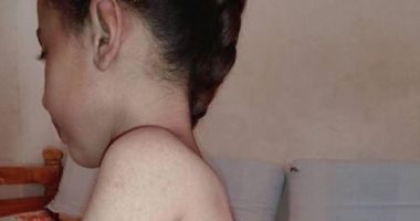 فيديو.. الطفلة "رحاب" مصابة بضمور النخاع الشوكى ووالدها يطالب بعلاجها فى الخارج
