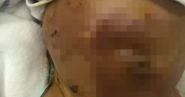 فيديو وصور.. قارئة تشكو طبيب بعد انفجار بطن طفلتها واستئصال جزء من الأمعاء