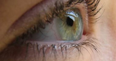 أضرار جفاف العين عديدة منها التهاب القرنية