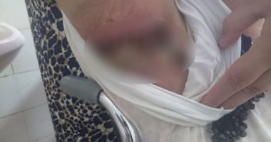 مواطنة تستغيث بوزارة الصحة بعد شلل ذراعيها نتيجة الإهمال الطبى