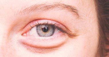 لو المود طالب عياط.. 5 وصفات طبيعية لعلاج انتفاخ العيون