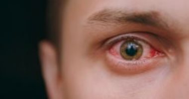 علاج نزيف العين .. الأدوية المضادة للفطريات الأبرز