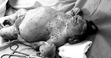 صور.. ولادة طفلة بتشوهات نادرة فى مستشفى العامرية العام بالإسكندرية