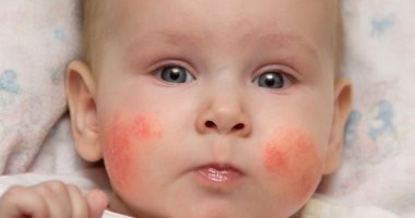علاج الطفح الجلدى عند الاطفال بطرق عدة منها مكعبات الثلج