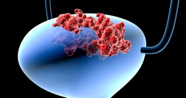 دراسة: سلالة من فيروس البرد يمكن أن تساعد فى علاج سرطان المثانة