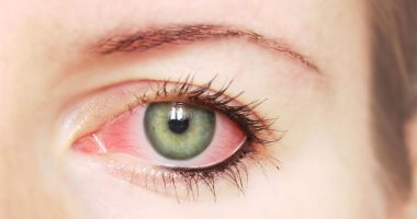 أسباب نزيف العين وطرق العلاج